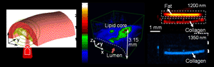 Image: A "vibrational photoacoustic" image showing the plaque in an arterial wall (Photo courtesy of Purdue University Weldon School of Biomedical Engineering image/Han-Wei Wang and Ji-Xin Cheng).